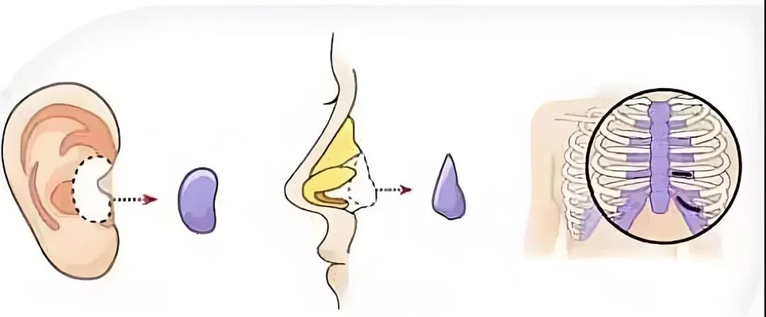 长沙肋软骨隆鼻价格参考，做鼻子要多少钱？插图