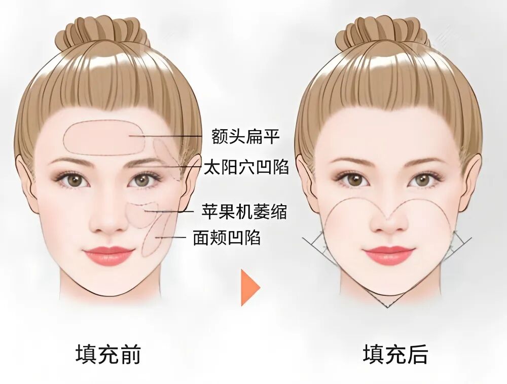 自体脂肪填充全脸痛吗?科普自体脂肪填充过多的补救方法插图 自体脂肪填充全脸痛吗?科普自体脂肪填充过多的补救方法插图