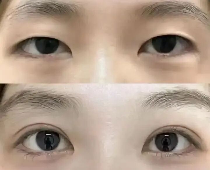上海双眼皮价格是多少?解析影响双眼皮价格的4大因素插图 上海双眼皮价格是多少?解析影响双眼皮价格的4大因素插图