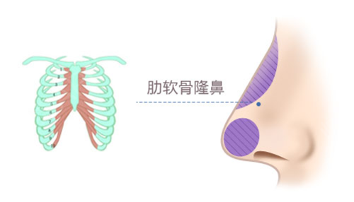 长沙肋软骨隆鼻价格参考，做鼻子要多少钱？插图1