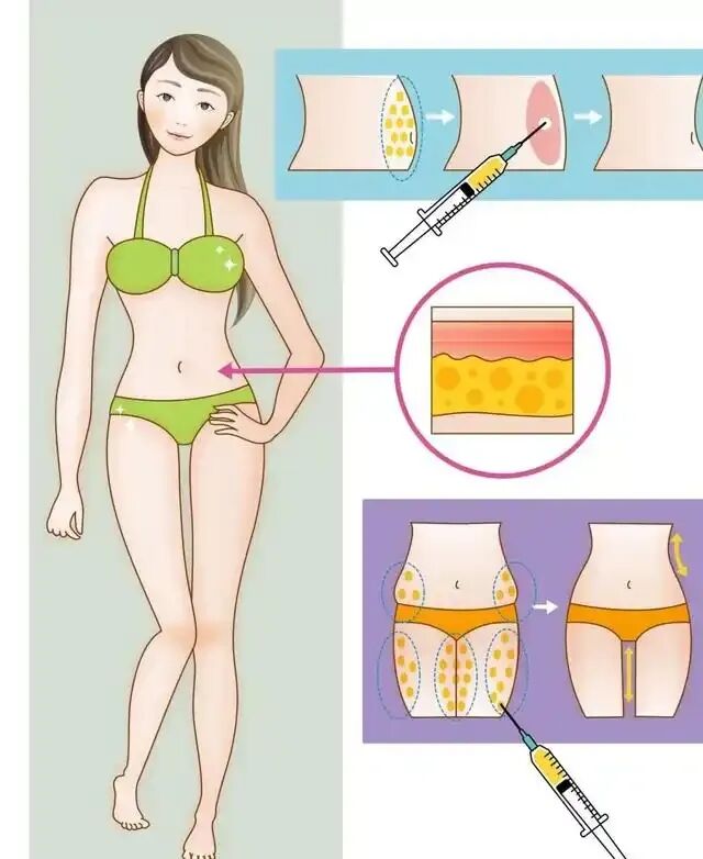 大腿吸脂术后的护理要点有哪些?大腿吸脂手术原理插图 大腿吸脂术后的护理要点有哪些?大腿吸脂手术原理插图