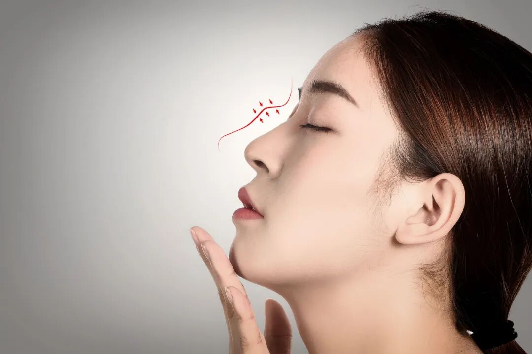 自体软骨隆鼻方式有哪些?自体软骨隆鼻在哪取软骨好插图 自体软骨隆鼻方式有哪些?自体软骨隆鼻在哪取软骨好插图