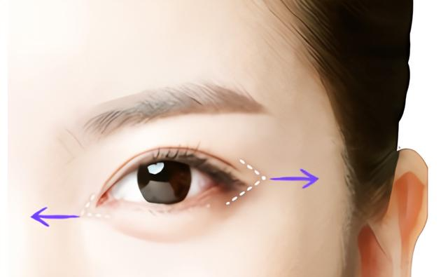 双眼皮有哪些类型?常见的双眼皮手术有几种插图 双眼皮有哪些类型?常见的双眼皮手术有几种插图