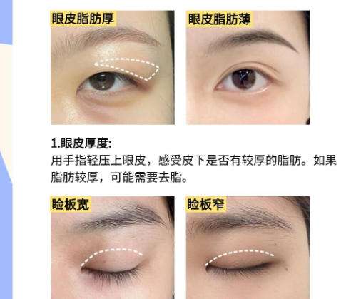 金石峰双眼皮效果图片揭示！含医生详细介绍及真实口碑点评插图4