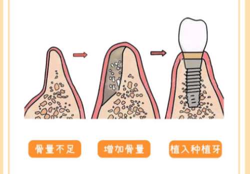 北京种牙多少钱一颗啊？2026牙科种植牙收费价目表更新！插图1