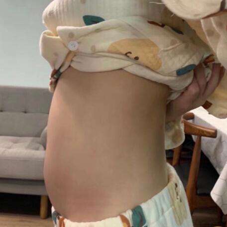 斯良洪腰部抽脂案例分析插图1 斯良洪腰部抽脂案例分析插图1