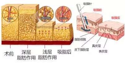 成都王欣医生吸脂多少钱？华生铂悦威塑抽脂价格6千元起，修复2-4万不等插图