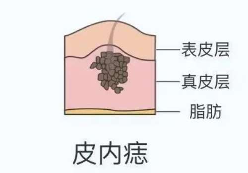 吴信峰切痣效果真实评价！缝合精细、看不出疤痕插图2