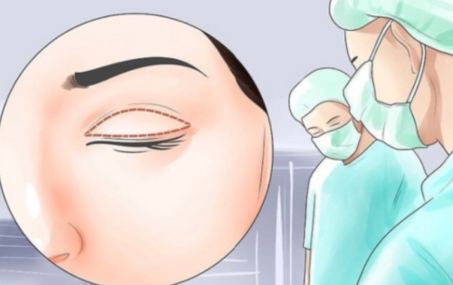 东莞人民医院双眼皮修复多少钱?常见问题修复方案+价格区间插图 东莞人民医院双眼皮修复多少钱?常见问题修复方案+价格区间插图