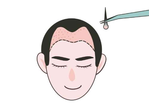 北京安贞医院植发价格多少?低至8k起!价格详情、医生、案例分析!插图 北京安贞医院植发价格多少?低至8k起!价格详情、医生、案例分析!插图