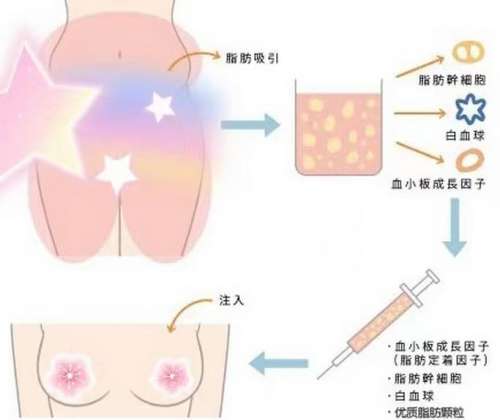 2026北京自体脂肪丰胸医生排名_隆胸价格,冯斌、任学会等技术牛插图 2026北京自体脂肪丰胸医生排名_隆胸价格,冯斌、任学会等技术牛插图