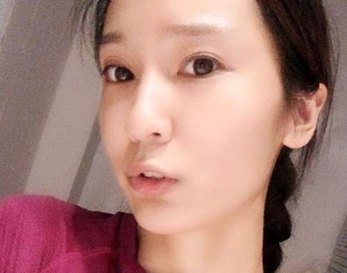 陈万芳脂肪填充面部案例分析插图4 陈万芳脂肪填充面部案例分析插图4