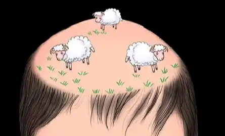 上海植发大概多少钱 · 预算范围,不同技术价格对比插图2 上海植发大概多少钱 · 预算范围,不同技术价格对比插图2
