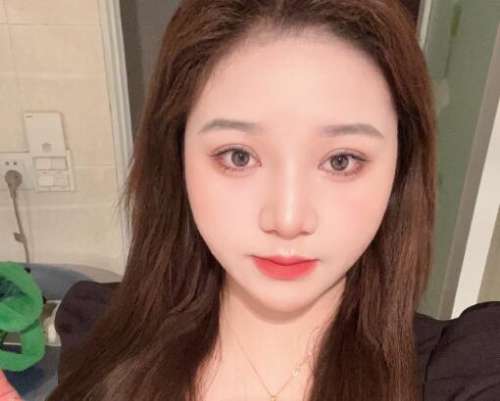 合肥褚燕军双眼皮案例，冰冷的形象变得温柔似水插图3