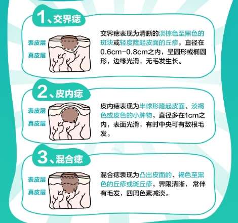 上海九院李东切痣怎么样？切痣技术剖析！费用低至7k左右插图2