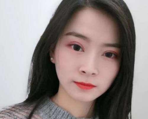 王琪影双眼皮案例，轻松打造明眸大眼插图3