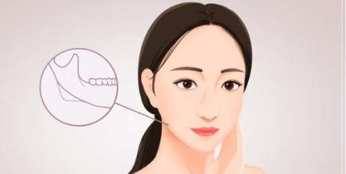 邱立东做下颌角怎么样?坐诊医院是哪家?下颌角案例分析插图2 邱立东做下颌角怎么样?坐诊医院是哪家?下颌角案例分析插图2