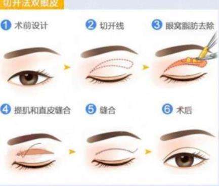 张诚教授做眼修复怎么样插图1 张诚教授做眼修复怎么样插图1