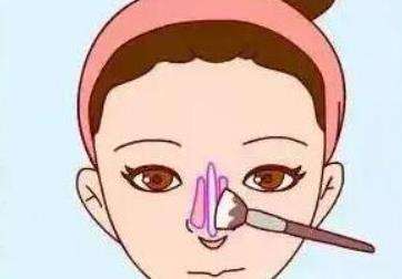 上海刘超医生鼻修复技术怎么样?项目科普知识!术前必看!插图3 上海刘超医生鼻修复技术怎么样?项目科普知识!术前必看!插图3