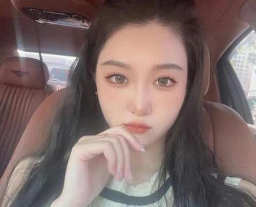 白明医生双眼皮手术案例，术后效果让我重拾自信插图2