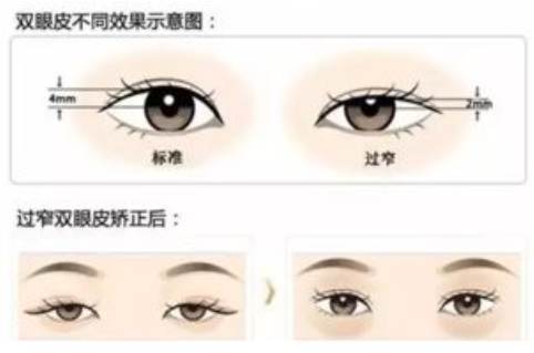 北京八大处于晓波做手术咋样？整形医学博士，互联网明星医生，擅长精细切开及失败修复插图1