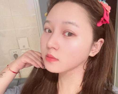 合肥褚燕军双眼皮案例，冰冷的形象变得温柔似水插图1