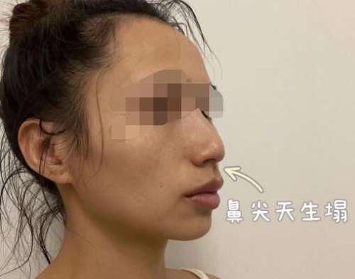 成都蔡震做鼻子怎么样?医生技术点评+隆鼻案例分享插图1 成都蔡震做鼻子怎么样?医生技术点评+隆鼻案例分享插图1