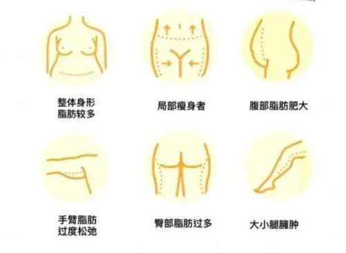 刘纬驰医生吸脂的口碑怎么样？真实水平揭秘！含案例插图3