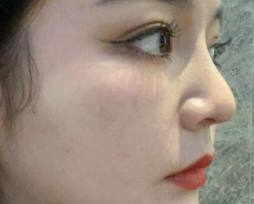 陈小平鼻基底案例，精致美鼻轻松打造插图2