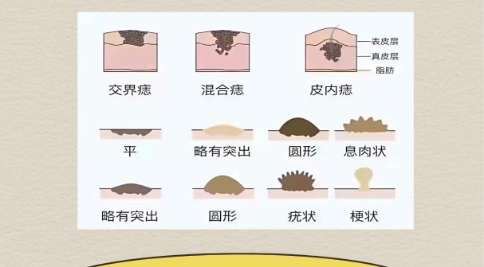上海九院李东切痣怎么样？切痣技术剖析！费用低至7k左右插图1