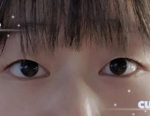 陈贵宗双眼皮案例，让美从窗户开始插图1