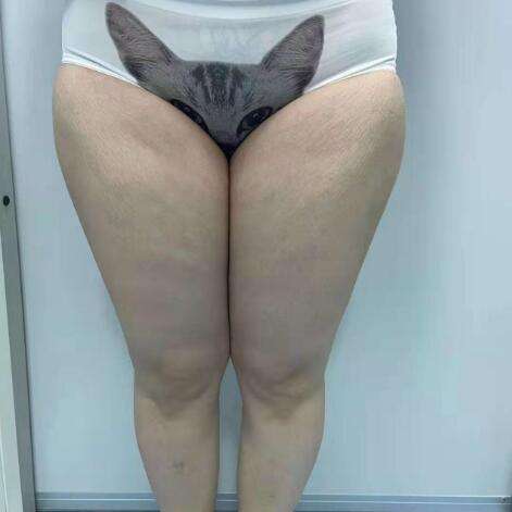 王世虎大腿吸脂案例分析插图1