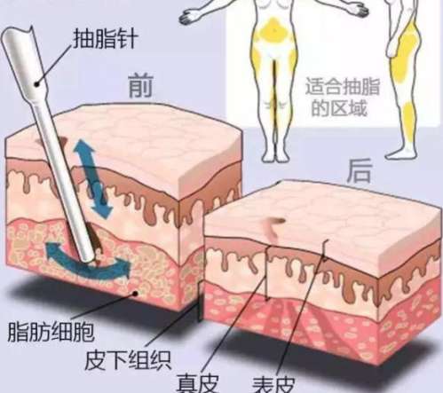 陈伟医生吸脂评价咋样？西安吸脂人气医生，网友反馈：多层吸脂平整度高！插图2