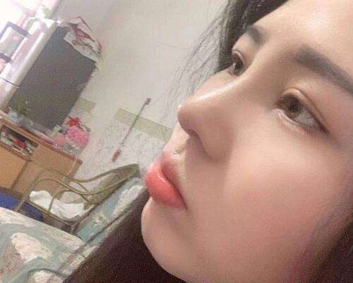 戴传昌做鼻子案例，术后收获脸部立体感插图2