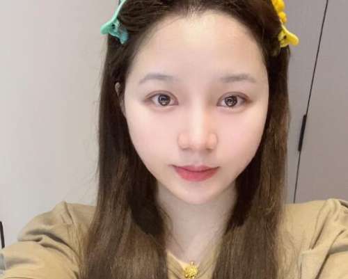 合肥褚燕军双眼皮案例，冰冷的形象变得温柔似水插图2