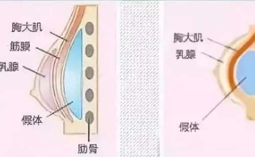 栾杰医生隆胸技术好不好?收费贵吗?插图 栾杰医生隆胸技术好不好?收费贵吗?插图