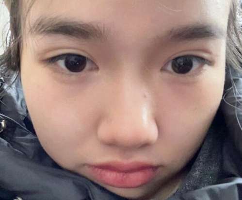 吉大一院董雪双眼皮案例，打造精致美眼如此简单插图2