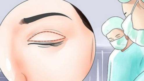 张余光双眼皮做得好吗？就诊流程公布！来看前后效果图插图4
