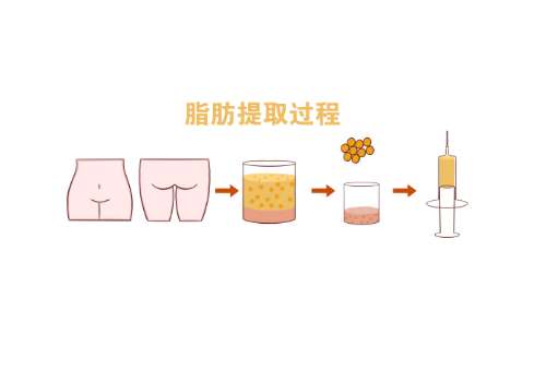 北京协和医院眼部脂肪填充多少钱？低至5000元起，放心入插图2