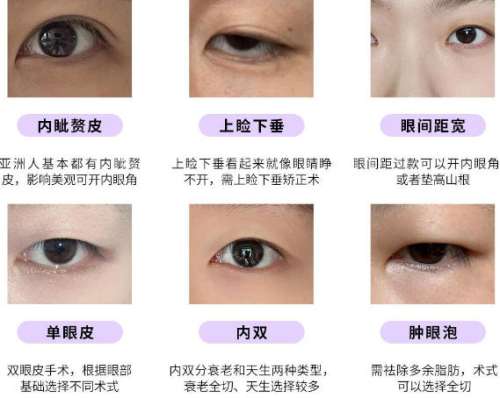 湖南省人民医院李高峰双眼皮案例展示！详细流程等你来看！含价格表插图2