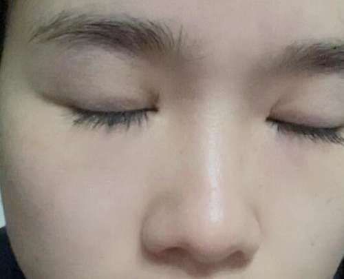吉大一院董雪双眼皮案例，打造精致美眼如此简单插图1