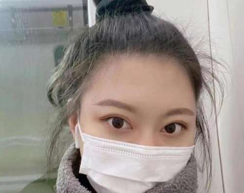 高一生张林宏医生双眼皮手术案例，技术与审美的绝佳配合插图3