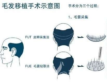 汤宋佳植发多少钱一个单位?2026收费标准8-20元/单位,技术解析_挂号攻略插图1 汤宋佳植发多少钱一个单位?2026收费标准8-20元/单位,技术解析_挂号攻略插图1