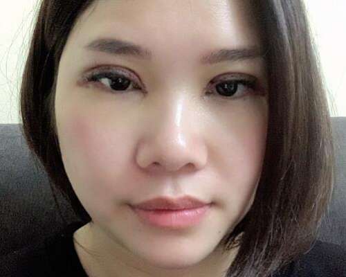 高海鹰医生双眼皮案例，塑造看得见的美丽插图2