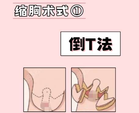 辛敏强缩胸缩胸手术费用贵不贵？医生基本信息、热门项目盘点！插图1
