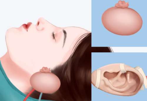 北京协和医院王友彬怎么样？隆胸、耳朵整形技术剖析！插图2