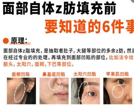 哈尔滨脂肪填充专家名单更新！罗赛、李庆春技术好！放心选插图4