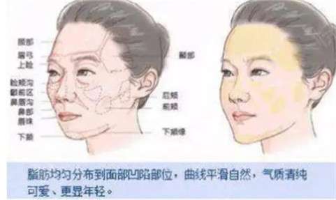 曹玉娇脂肪填充怎么样？医生经验丰富、综合实力强！插图1