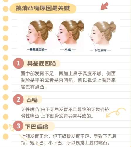 南昌凸嘴矫正多少钱?推荐医院名单如下!收藏再看!插图4 南昌凸嘴矫正多少钱?推荐医院名单如下!收藏再看!插图4