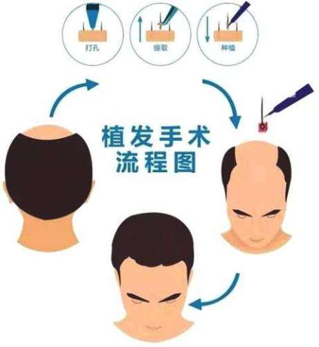 男生植发大概需要多少钱？2026价格表_正规公立医院实力分析插图